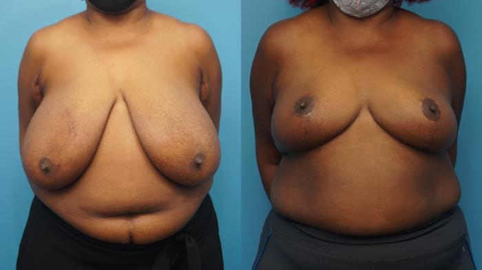 Before & After Breast Reduction Case 362 Front View in North Shore, IL