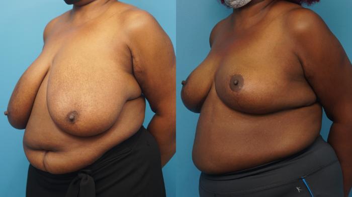 Before & After Breast Reduction Case 362 Left Oblique View in North Shore, IL