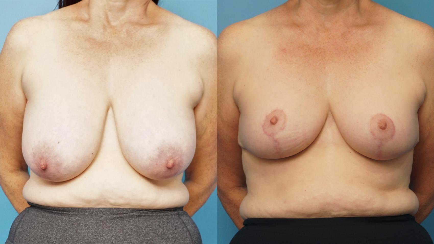 Before & After Breast Reduction Case 363 Front View in North Shore, IL