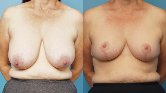 Before & After Breast Reduction Case 363 Front View in North Shore, IL