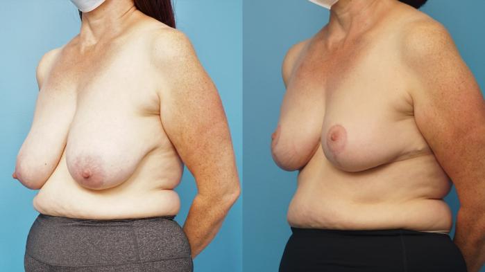 Before & After Breast Reduction Case 363 Left Oblique View in North Shore, IL