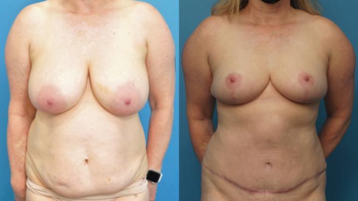 Before & After Breast Reduction Case 365 Front View in Northbrook, IL