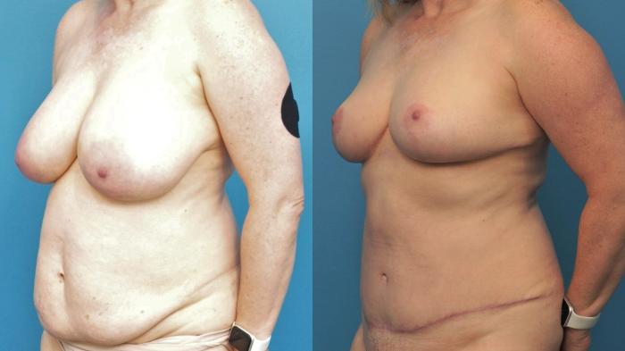 Before & After Breast Reduction Case 365 Left Oblique View in Northbrook, IL