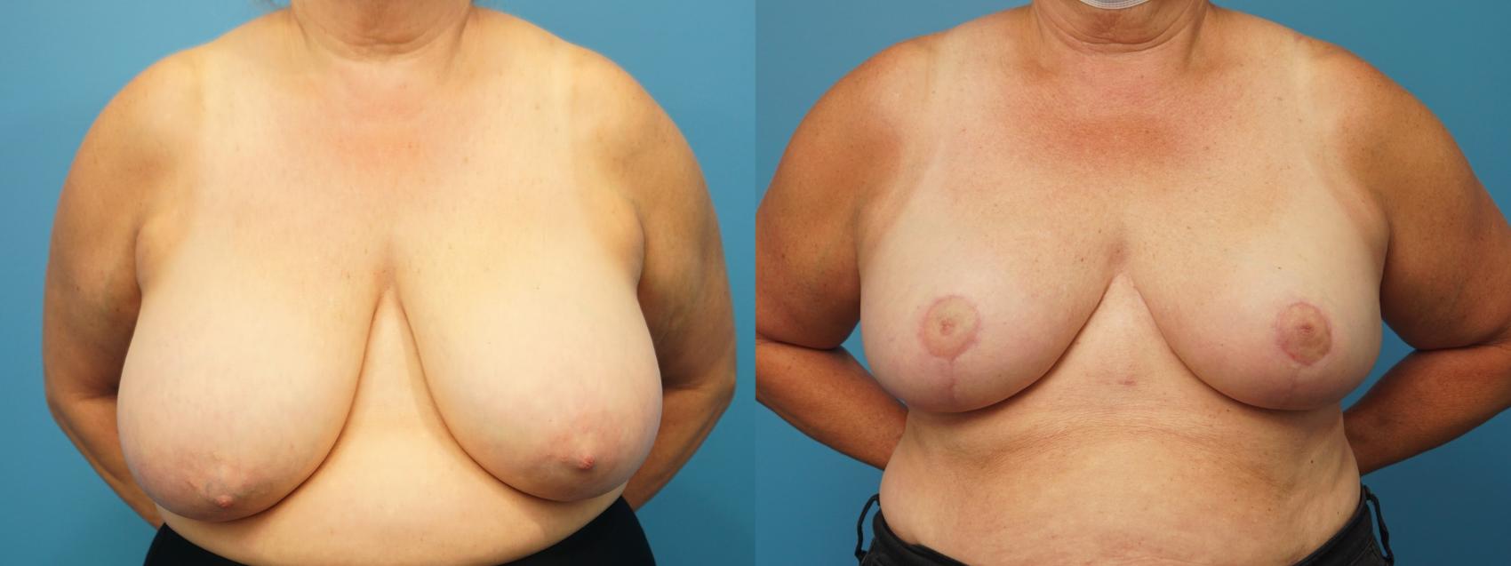 Before & After Breast Reduction Case 370 Front View in Northbrook, IL
