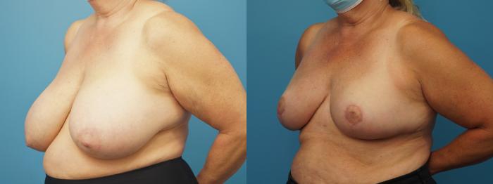 Before & After Breast Reduction Case 370 Left Oblique View in Northbrook, IL