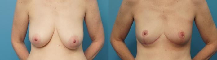 Before & After Breast Reduction Case 378 Front View in North Shore, IL