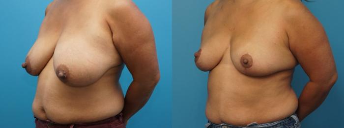 Before & After Breast Reduction Case 384 Left Oblique View in North Shore, IL