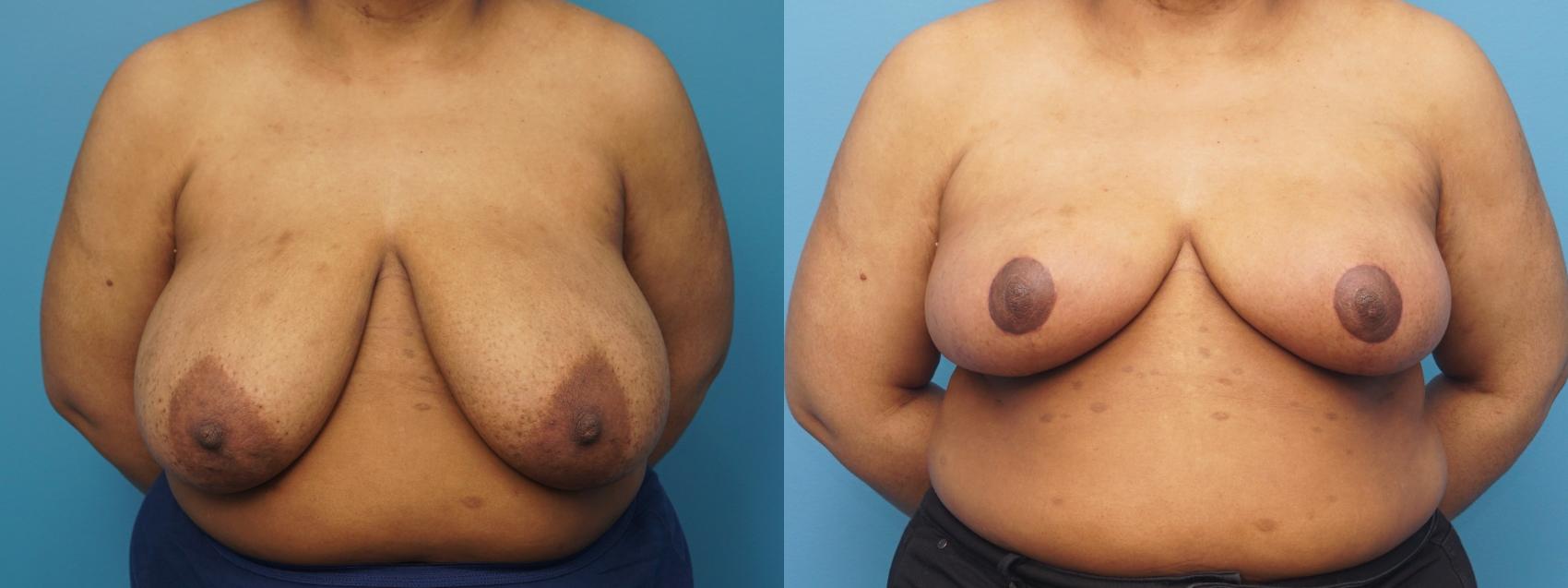 Before & After Breast Reduction Case 386 Front View in North Shore, IL