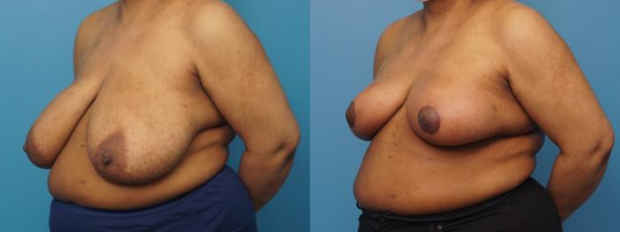 Before & After Breast Reduction Case 386 Left Oblique View in North Shore, IL
