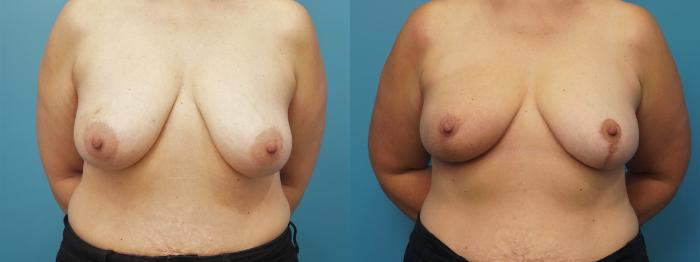 Before & After Breast Reduction Case 394 Front View in North Shore, IL