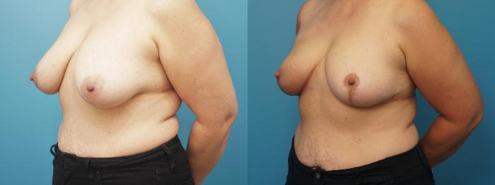 Before & After Breast Reduction Case 394 Right Oblique View in North Shore, IL