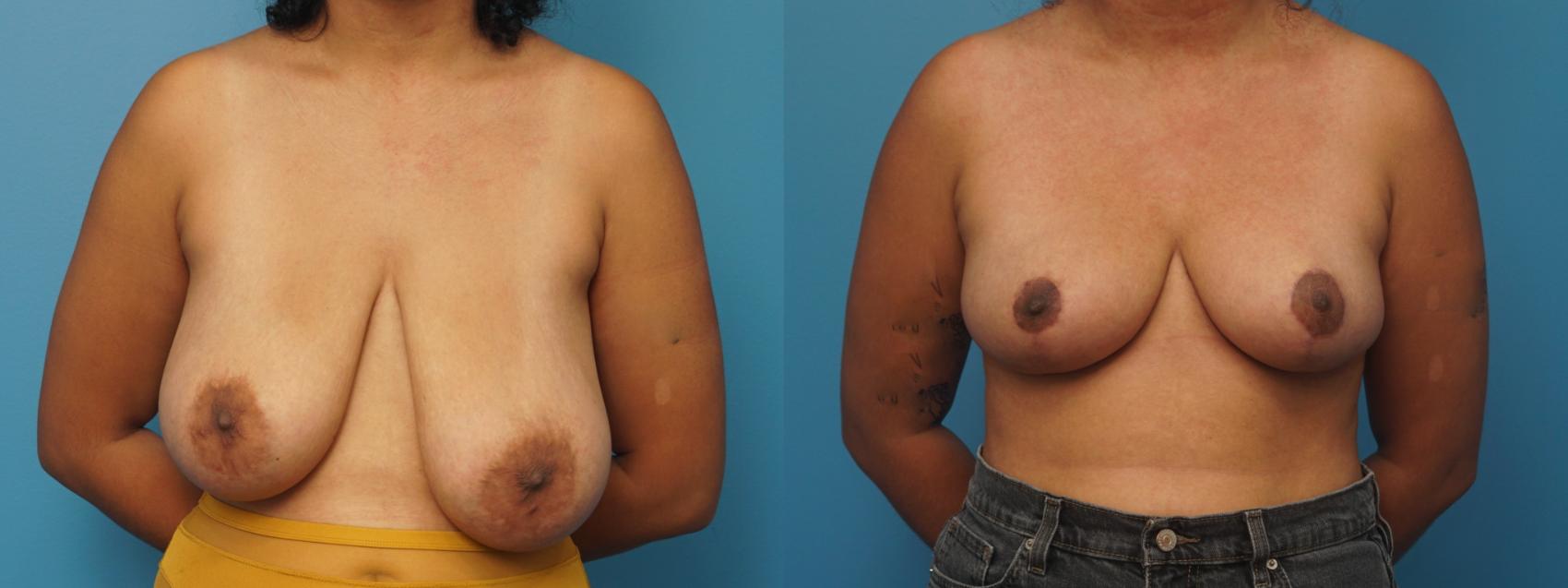 Before & After Breast Reduction Case 421 Front View in North Shore, IL