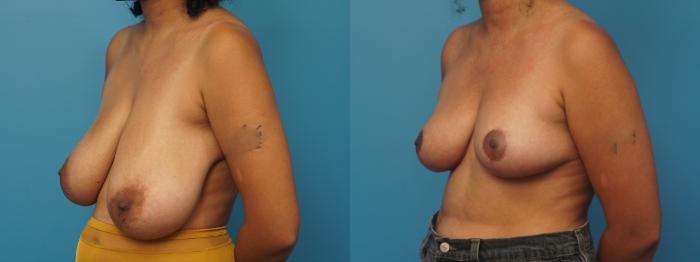 Before & After Breast Lift (Mastopexy) Case 421 Left Oblique View in North Shore, IL