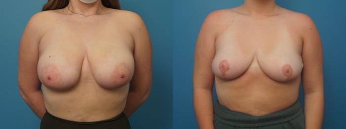 Before & After Breast Reduction Case 422 Front View in North Shore, IL