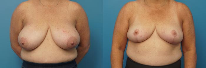 Before & After Breast Reduction Case 428 Front View in Northbrook, IL