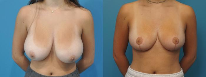 Before & After Breast Reduction Case 429 Front View in North Shore, IL