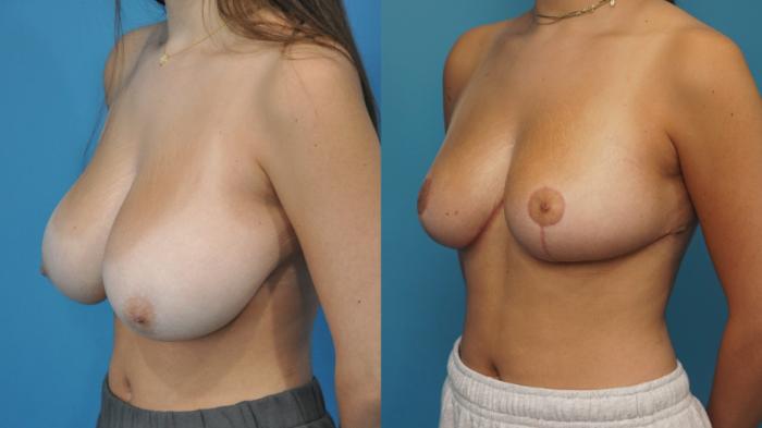 Before & After Breast Reduction Case 429 Left Oblique View in North Shore, IL