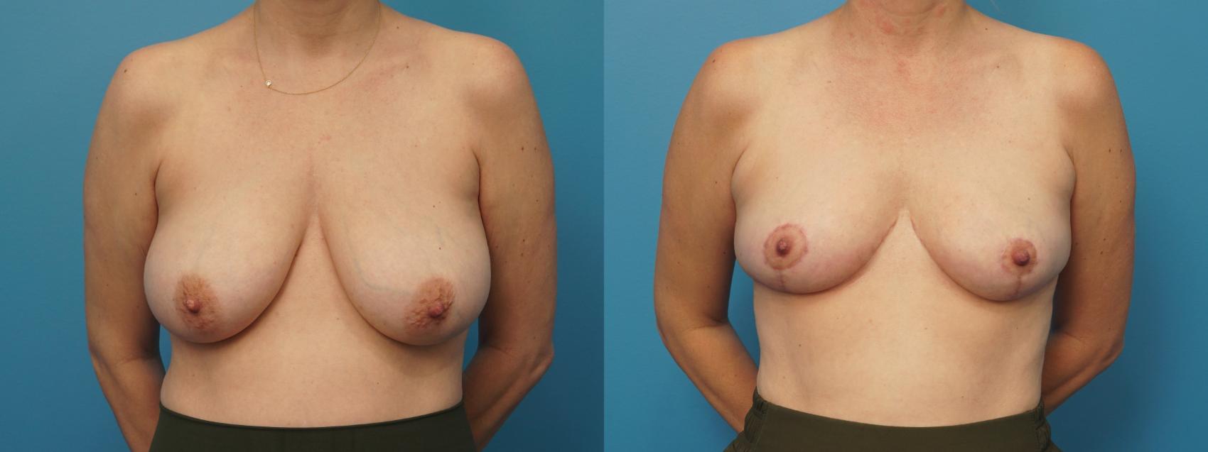 Before & After Breast Reduction Case 431 Front View in North Shore, IL