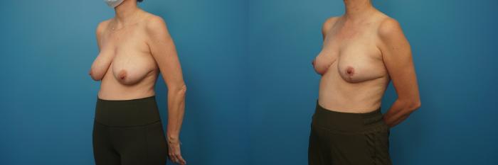 Before & After Breast Lift (Mastopexy) Case 431 Left Oblique View in North Shore, IL