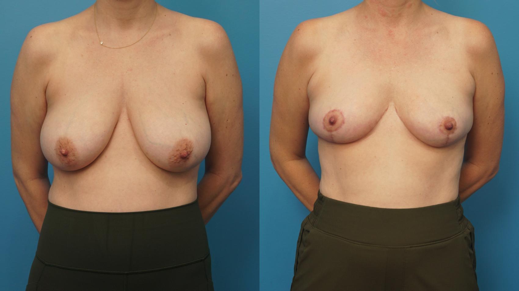 Before & After Breast Reduction Case 436 Front View in North Shore, IL