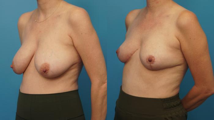 Before & After Breast Reduction Case 436 Left Oblique View in North Shore, IL