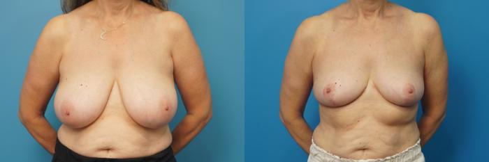 Before & After Breast Lift (Mastopexy) Case 462 Front View in North Shore, IL