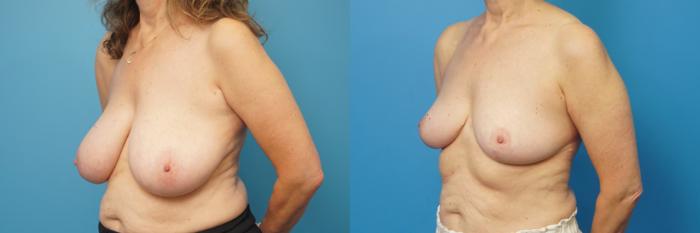 Before & After Breast Reduction Case 462 Left Oblique View in North Shore, IL