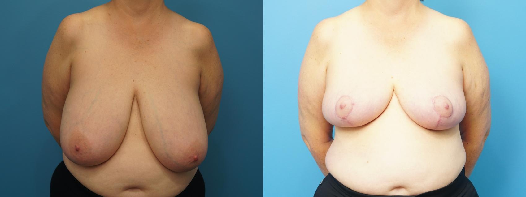 Before & After Breast Reduction Case 470 Front View in North Shore, IL