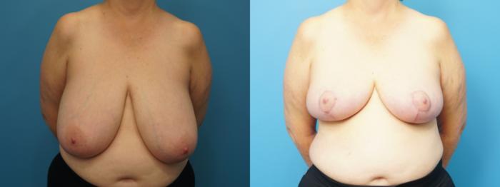 Before & After Breast Reduction Case 470 Front View in North Shore, IL