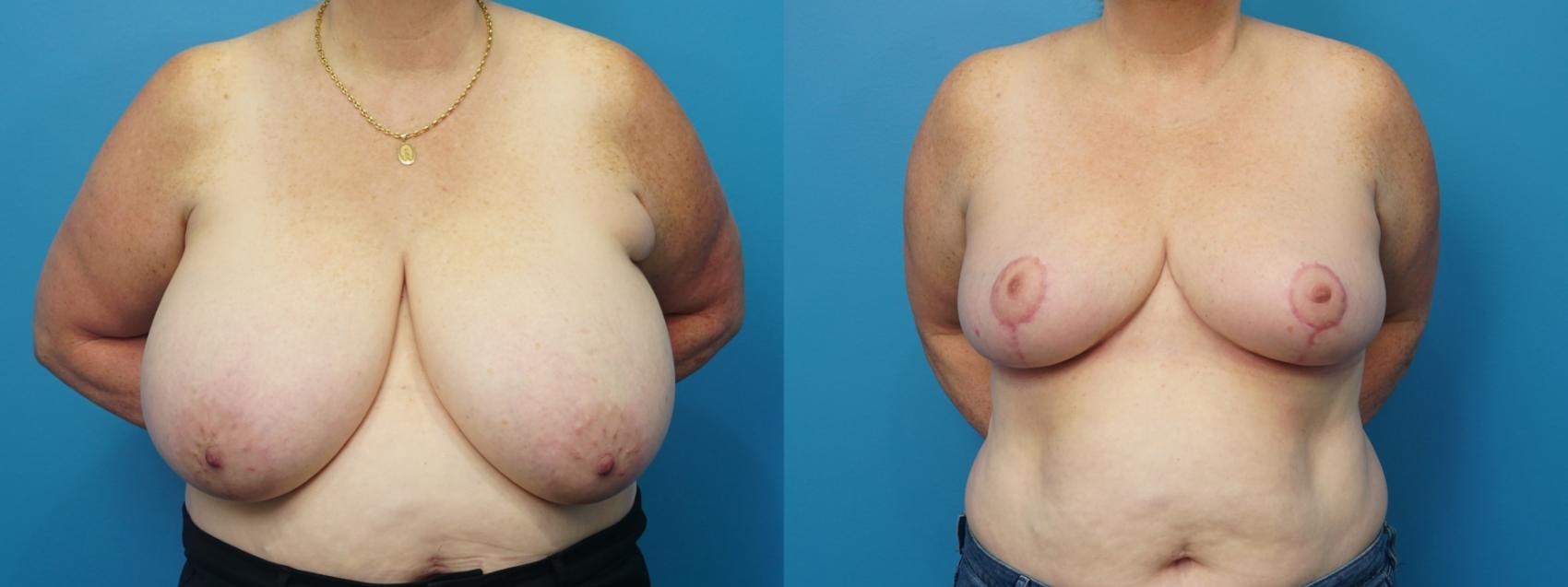 Before & After Breast Reduction Case 482 Front View in North Shore, IL