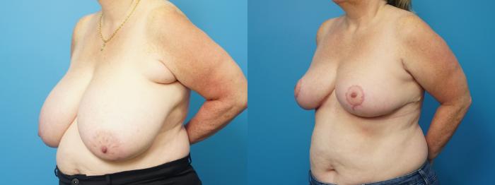 Before & After Axillary Breast Tissue Excision Case 482 Left Oblique View in North Shore, IL