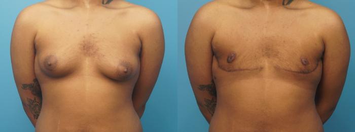 Before & After Gender Affirmation (Top Surgery) Case 387 Front View in Northbrook, IL