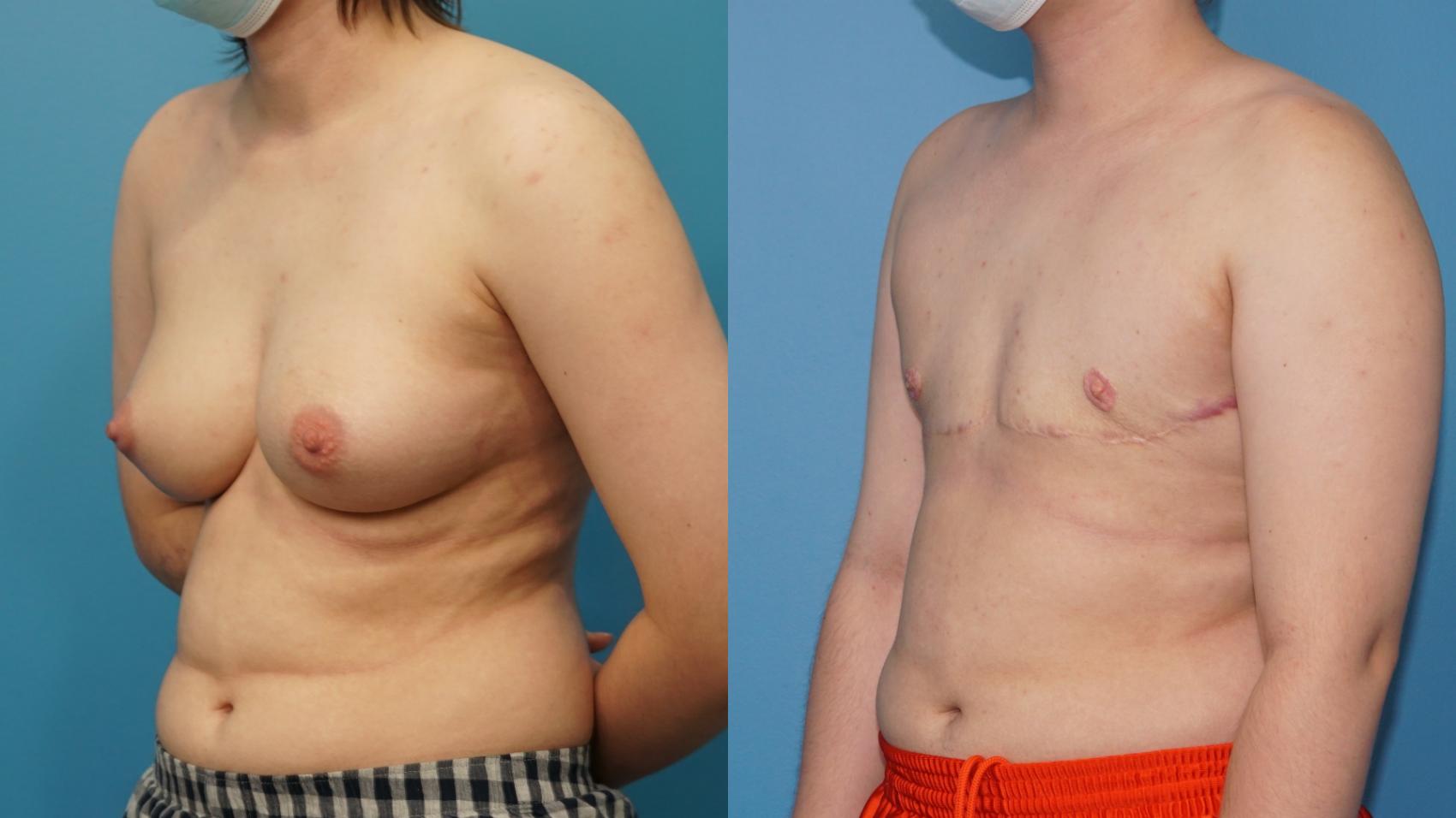 Before & After Gender Affirmation (Top Surgery) Case 397 Left Oblique View in North Shore, IL