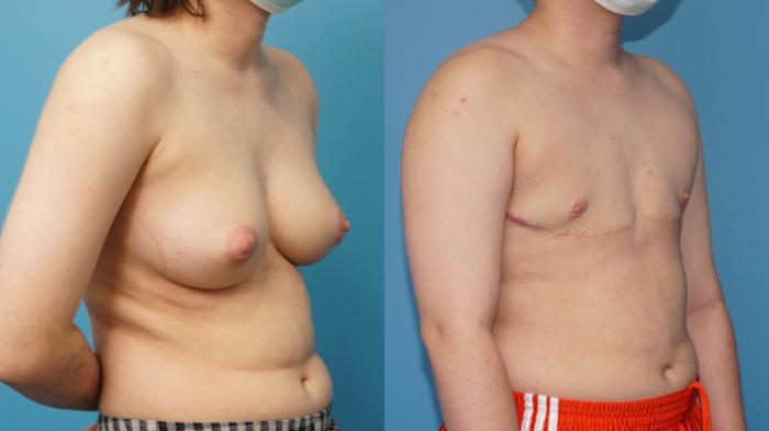 Before & After Gender Affirmation (Top Surgery) Case 397 Right Oblique View in North Shore, IL
