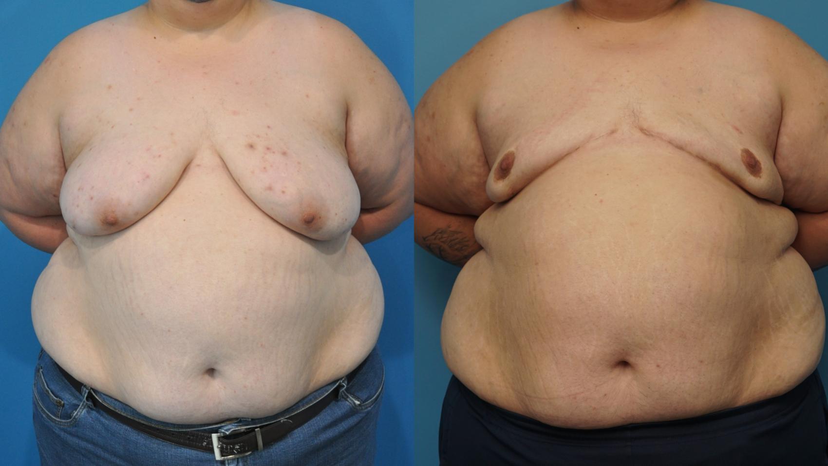 Before & After Gender Affirmation (Top Surgery) Case 416 Front View in North Shore, IL