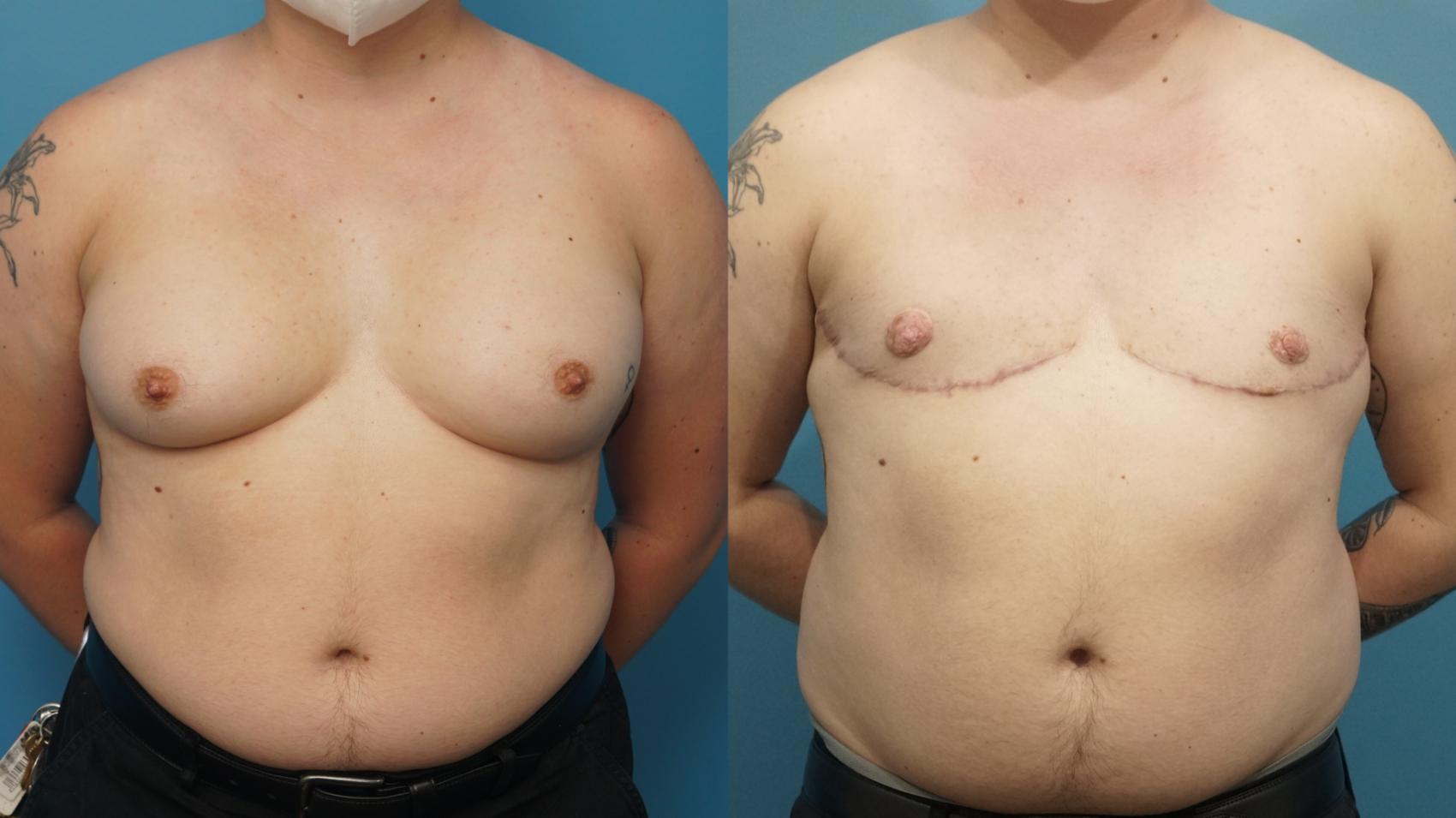 Before & After Gender Affirmation (Top Surgery) Case 438 Front View in North Shore, IL