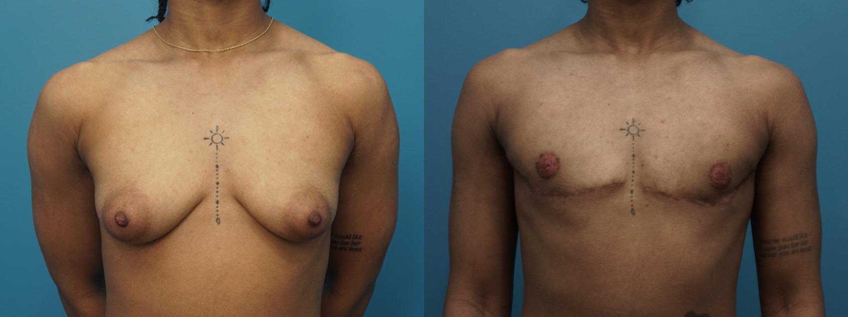 Before & After Gender Affirmation (Top Surgery) Case 439 Front View in North Shore, IL