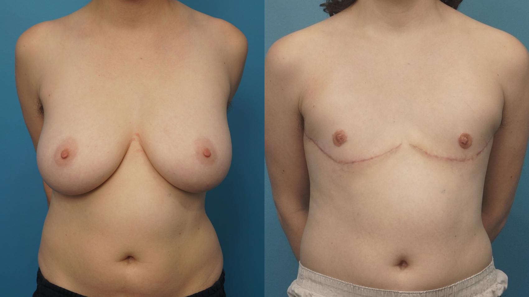 Before & After Gender Affirmation (Top Surgery) Case 443 Front View in North Shore, IL