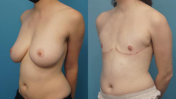 Before & After Gender Affirmation (Top Surgery) Case 443 Left Oblique View in North Shore, IL