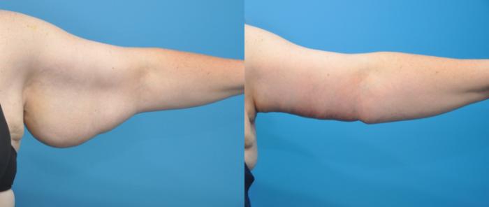 Before & After Liposuction Case 109 View #2 View in Northbrook, IL