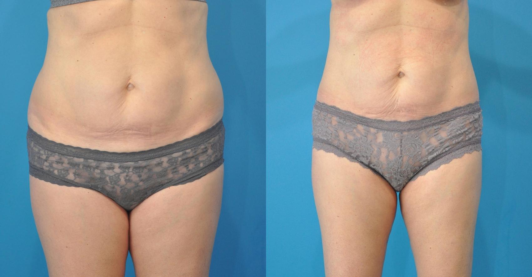 Before & After Liposuction Case 116 View #1 View in Northbrook, IL