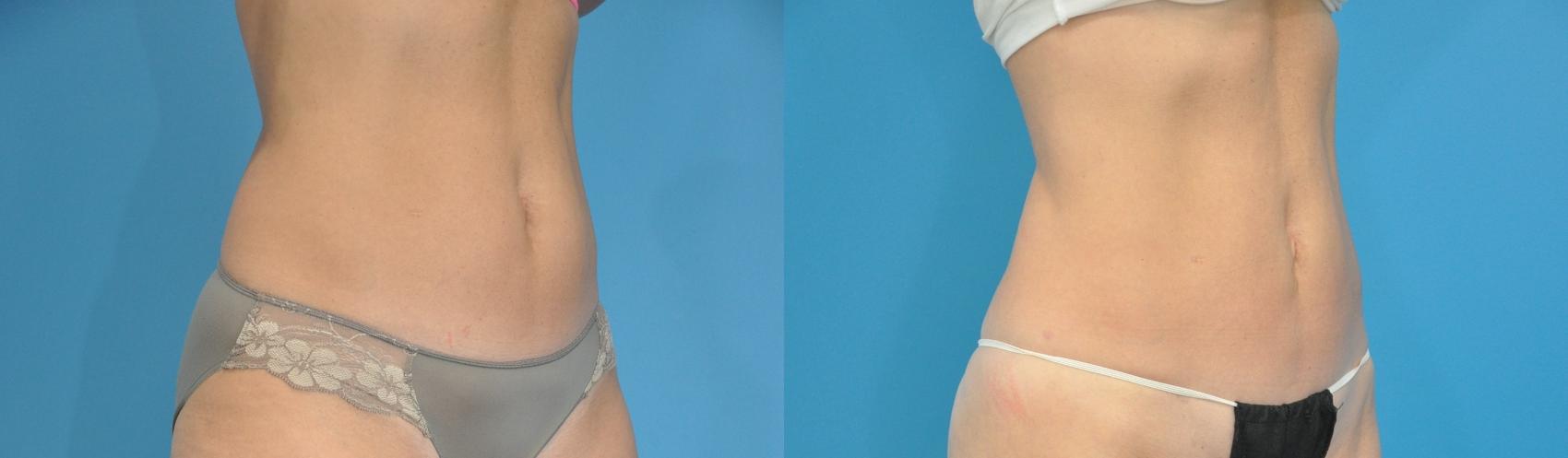 Before & After Liposuction Case 119 View #1 View in North Shore, IL