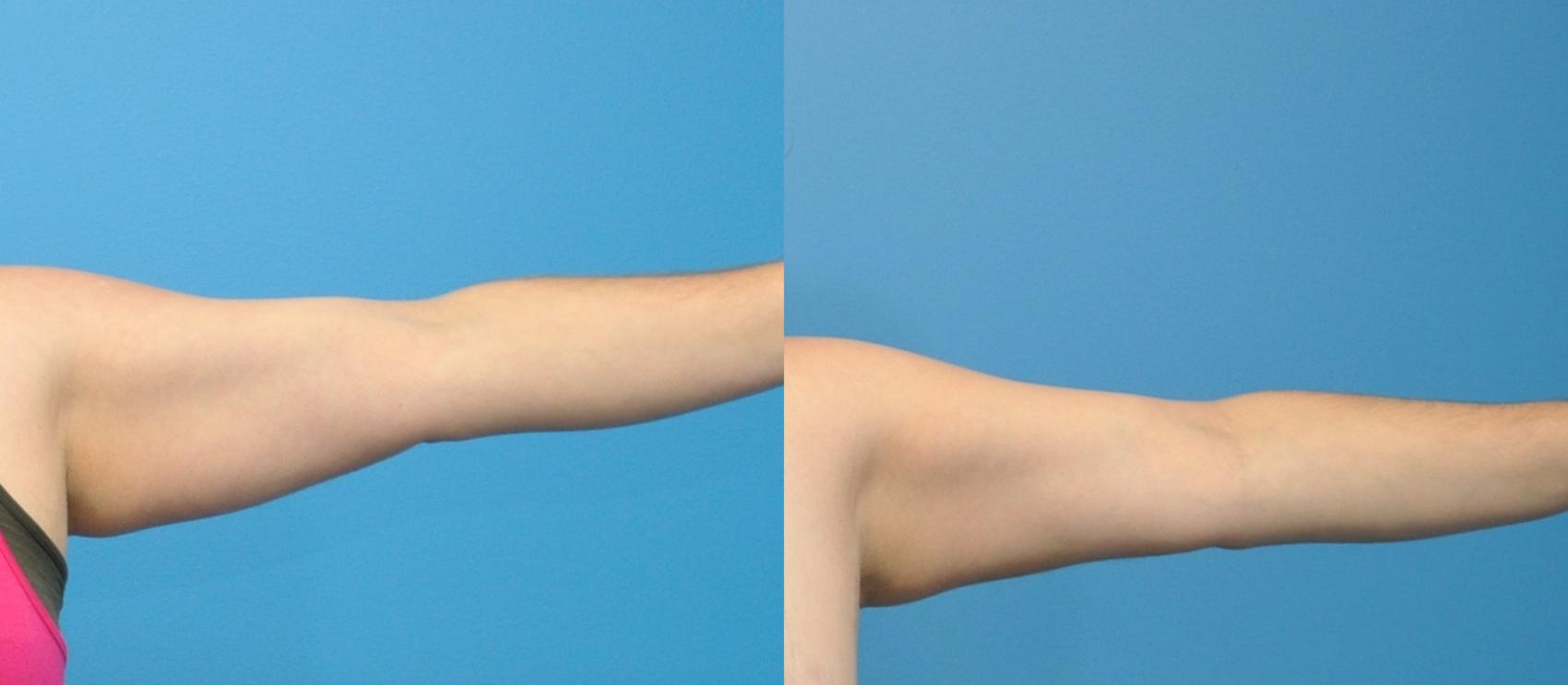 Before & After Liposuction Case 129 View #1 View in North Shore, IL