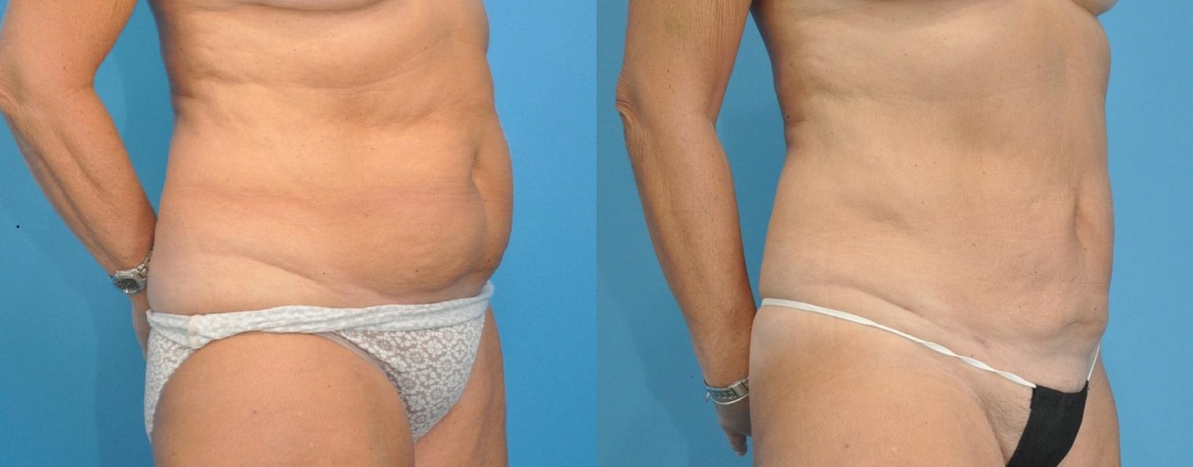Before & After Liposuction Case 133 View #1 View in Northbrook, IL
