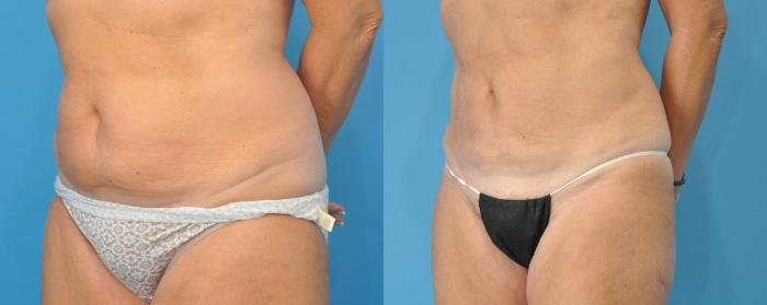 Before & After Liposuction Case 133 View #2 View in North Shore, IL