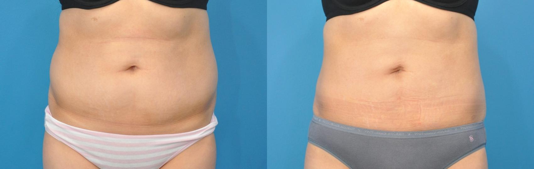 Chicago's Best Flank Fat Removal: Get Results Without Liposuction