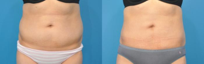 Before & After Liposuction Case 141 View #1 View in North Shore, IL