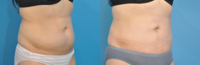 Before & After Liposuction Case 141 View #2 View in North Shore, IL