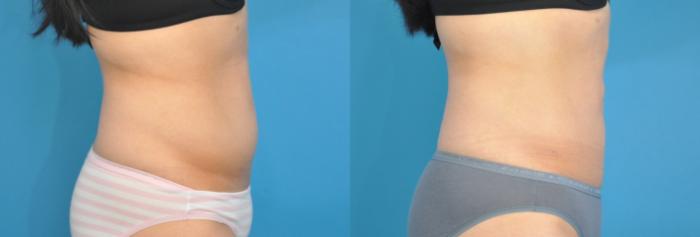 Before & After Liposuction Case 141 View #3 View in North Shore, IL