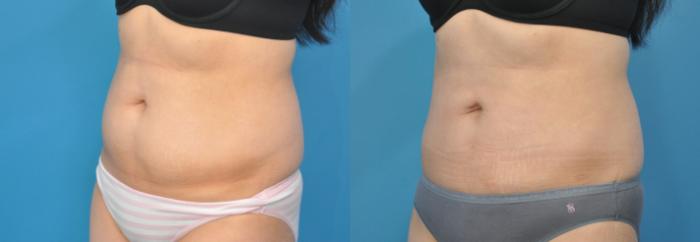 Before & After Liposuction Case 141 View #4 View in North Shore, IL